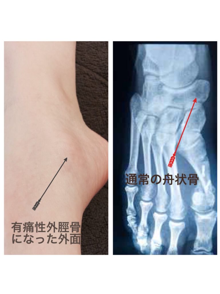 外脛骨 三角骨による痛み バレエ治療院あんじゅ