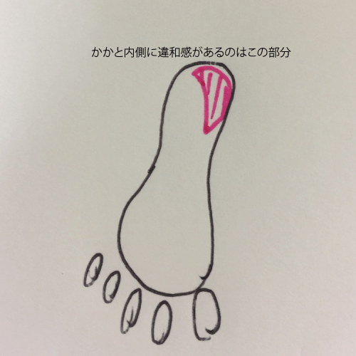 踵の内側が痛い、足底腱膜炎、バレエ治療院あんじゅ
