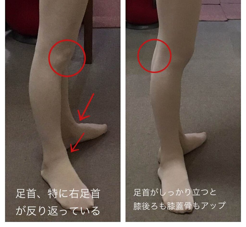 ターンアウトアップ アーンアウト 開脚の修正 改善 バレエ治療院あんじゅ
