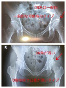 股関節のレントゲン、臼蓋の深さ浅さについて、股関節の可動域、バレエ治療院あんじゅ