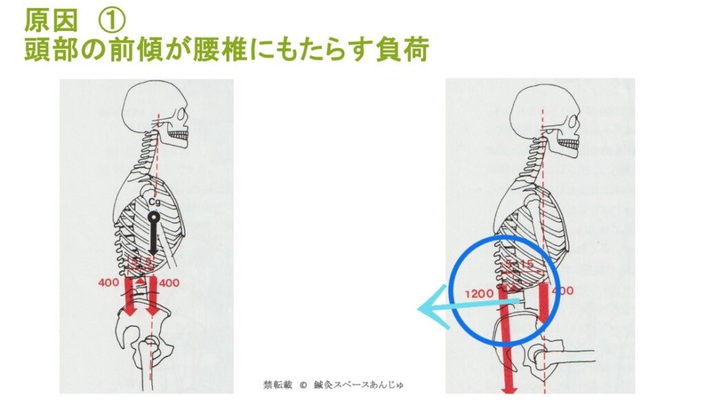 チアダンスの腰痛、原因はストレートな脊柱なのか？バレエ・ダンス専門治療院あんじゅ